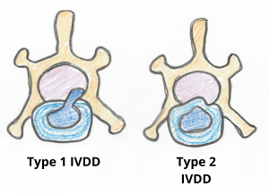 IVDD Type I and II IVDD Type I and II