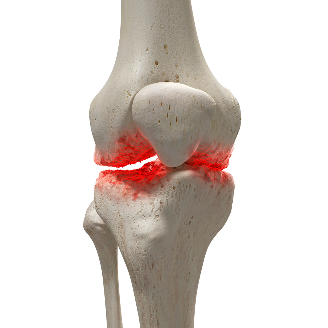 Knee Osteoarthritis
