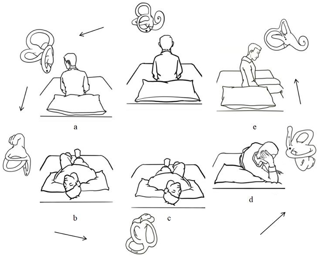 epley maneuver